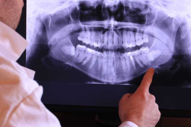 Best Emergency Wisdom Teeth Removal in Vicksburg, MI